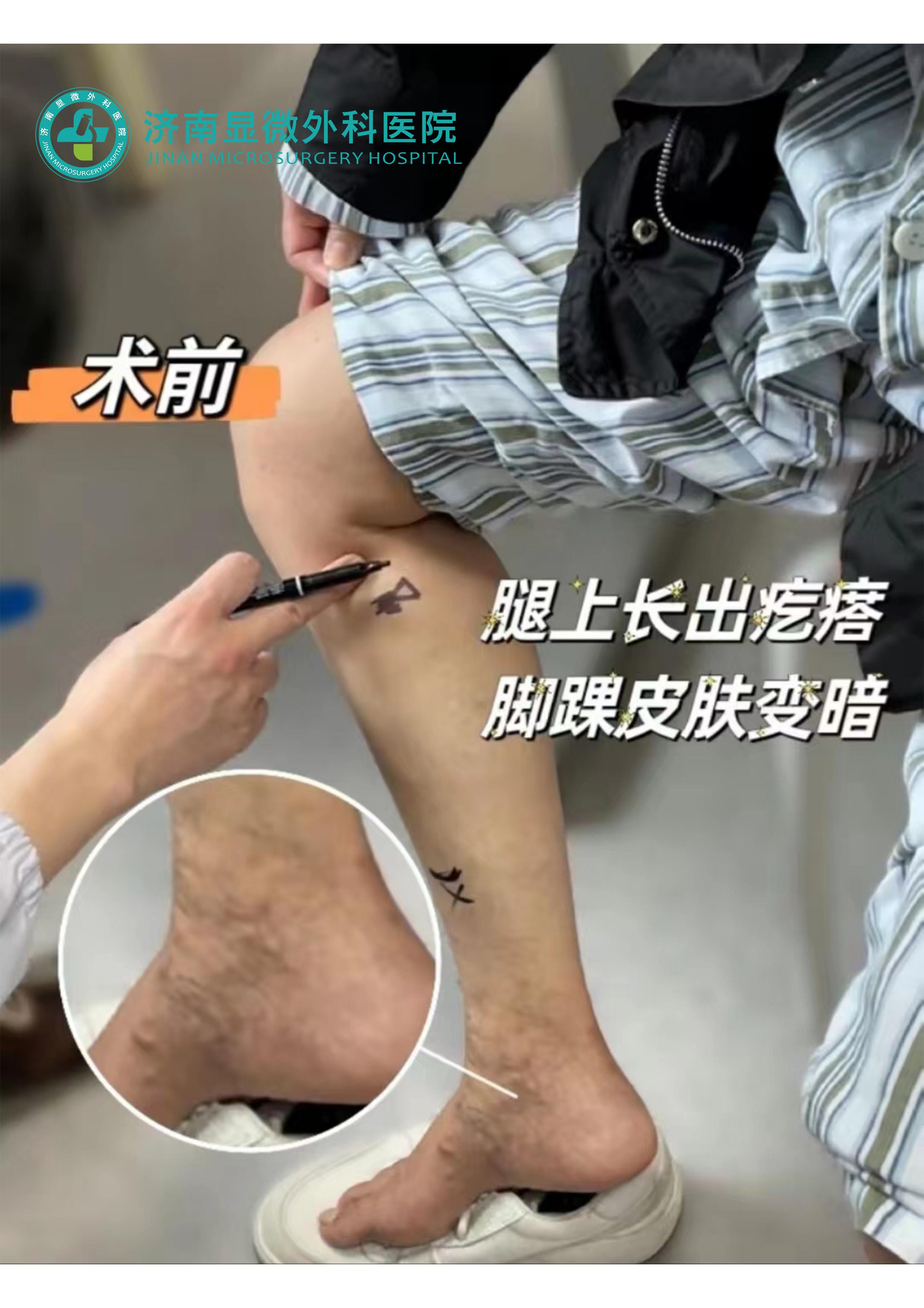 静脉曲张蚯蚓腿吃什么药,腿有静脉曲张怎样锻炼才好呢