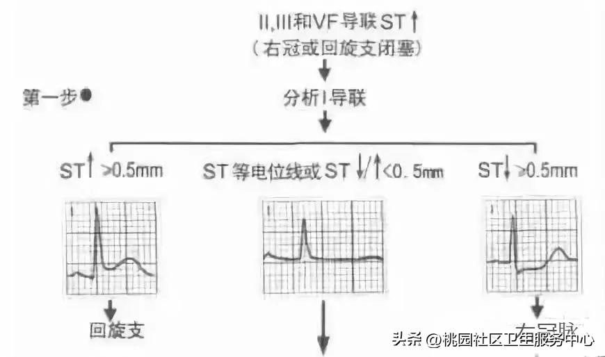 后循环梗死的识别,梗死分为哪三大类型