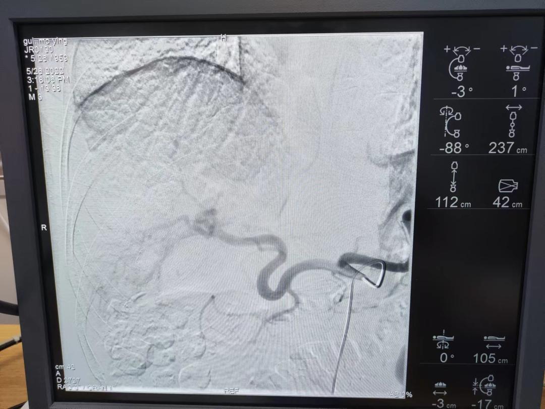 肝癌治疗出现奇迹,肝癌精准治疗