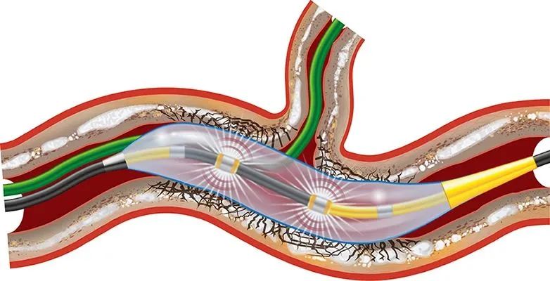 血管衰老的克星,血管钙化能做支架吗