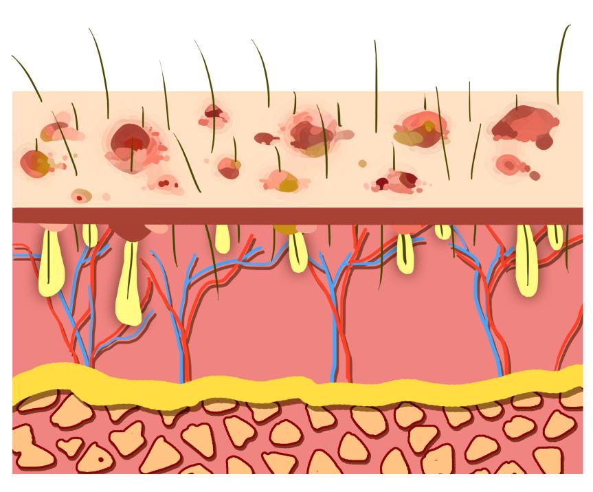 疱疹引起的脱皮怎么治疗,疱疹脱皮瘙痒是快好了吗
