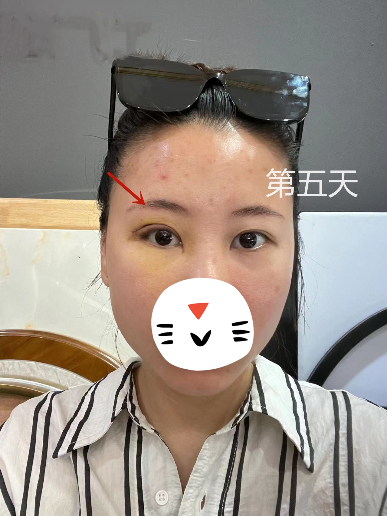 单眼上睑下垂恢复图,上眼睑下垂修复完大小眼明显