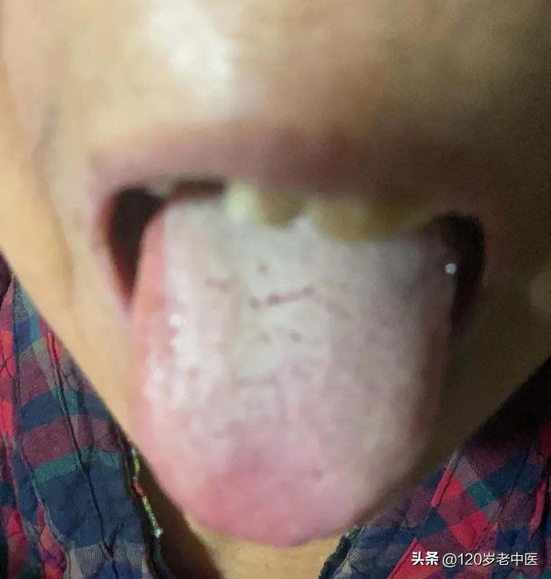 新冠感染后大便干燥可以考虑便宜又好用的防风通圣丸