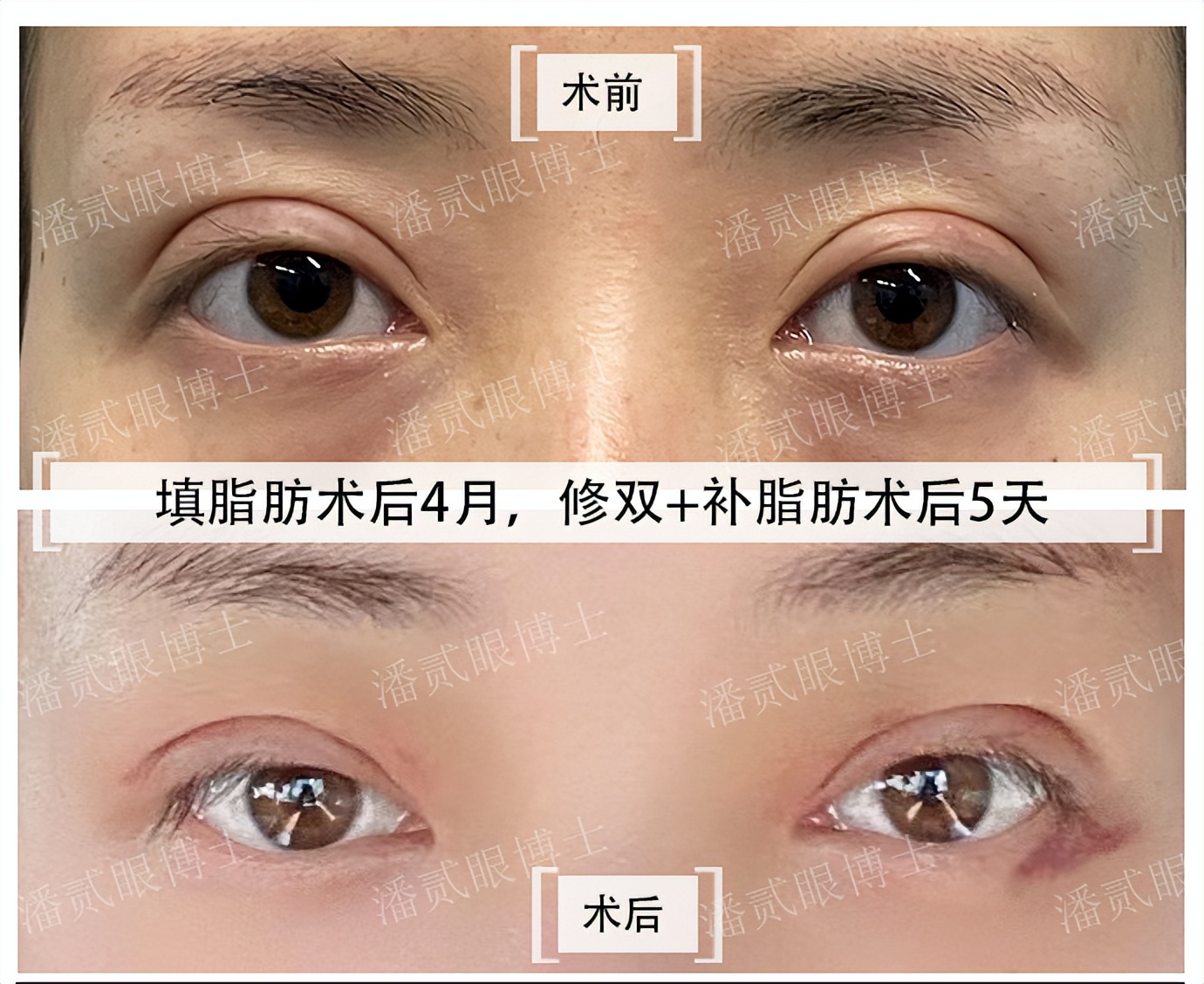 割双眼皮失败女的视频最新,割双眼皮失败女网红