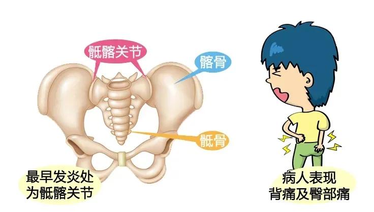 济南强直性脊柱炎脚后跟疼,强直性脊柱炎引起脚跟肿痛