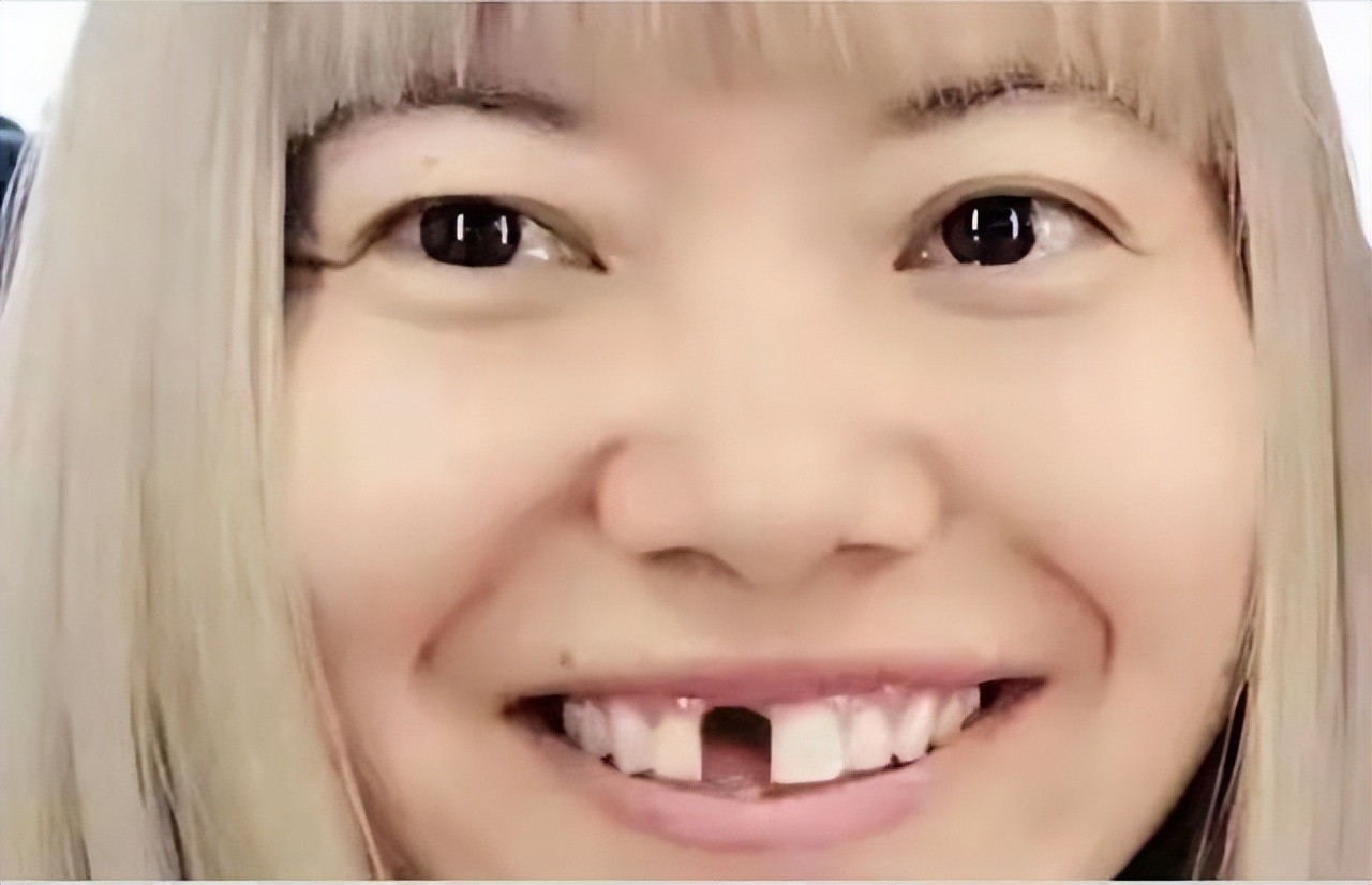 根管治疗烤瓷牙冠牙缝发黑,娱乐圈里都是谁是烤瓷牙