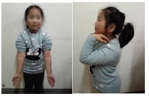 肱骨骨折取钢板怎样恢复,肱骨近端骨折切开复位内固定术