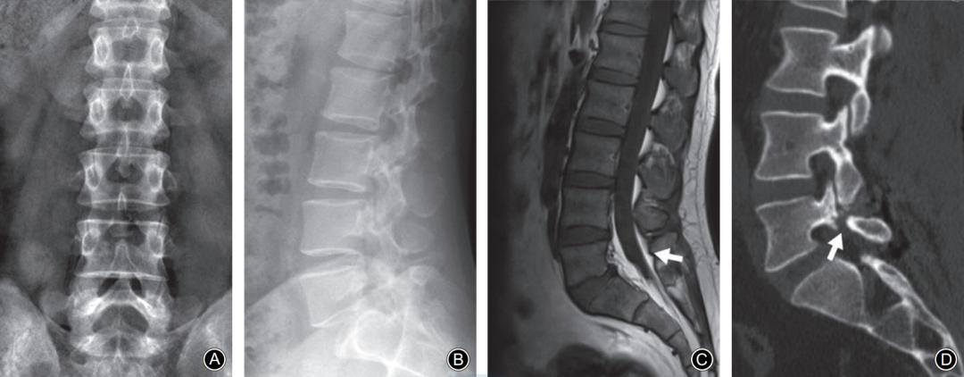 峡部裂和隐性峡部裂有区别吗,单纯峡部裂可以做峡部修复吗
