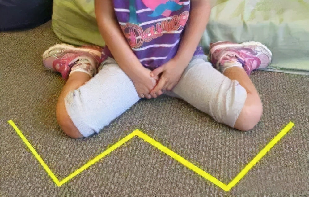 给新生儿绑腿科学吗,宝宝晚上绑腿睡觉能矫正腿型吗