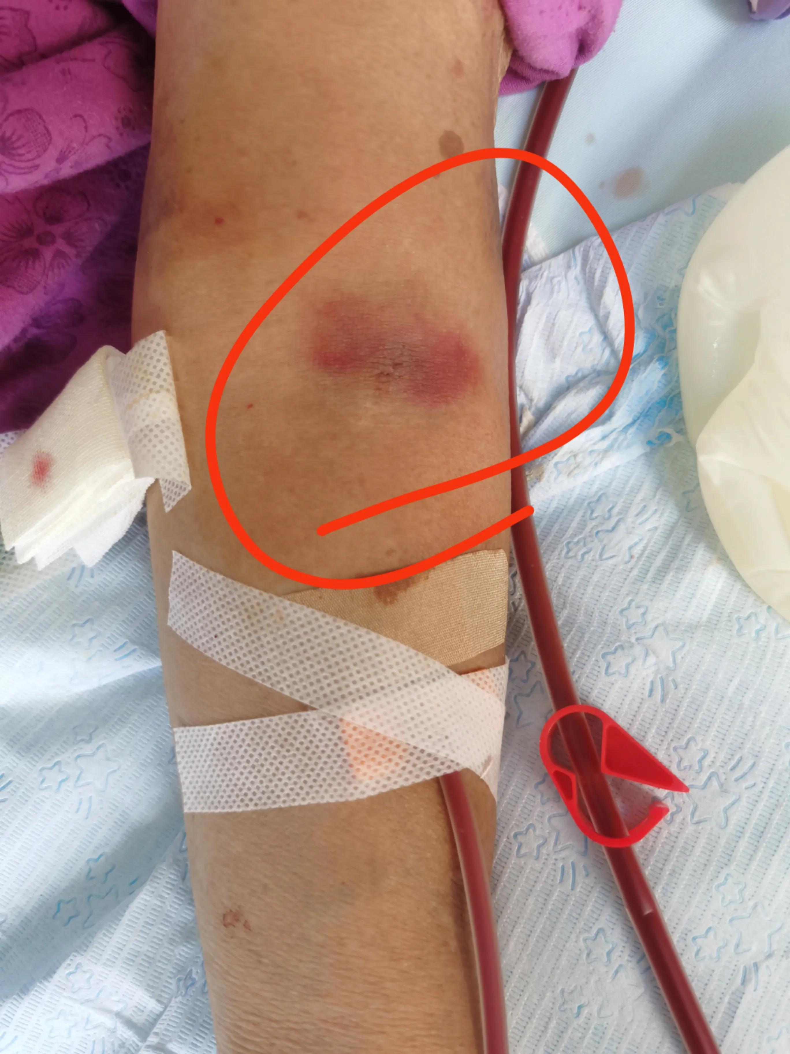 血管通路维护的意义,血管通路护理是怎样工作的