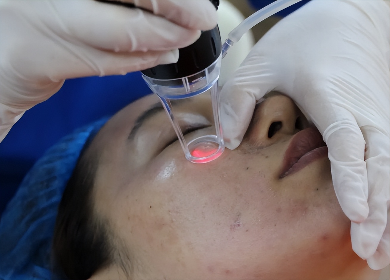 擦伤的疤痕变黑图片,小孩脸上擦伤后疤痕变黑怎么办