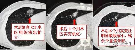 左肺上叶8*5mm磨玻璃结节最坏结果,发现肺磨玻璃小结节怎么办