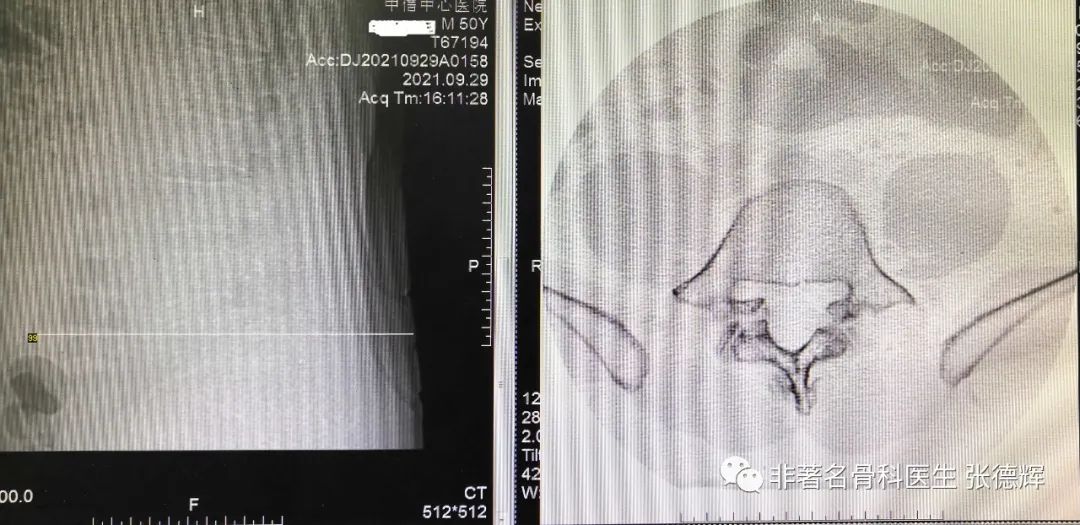 腰椎峡部裂的最好治疗方法,腰椎峡部裂