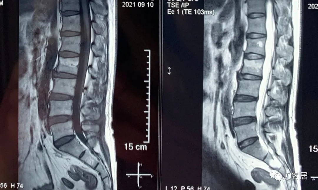 怎样治疗骨质疏松引起的腰椎骨折,骨质疏松性压缩骨折