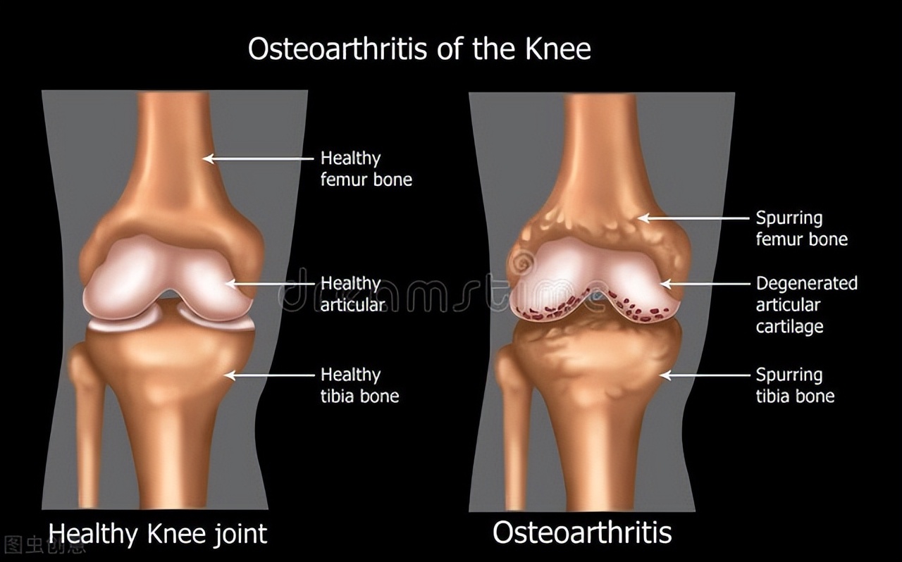 韩国干细胞治疗关节炎的疗效,prp与干细胞治疗膝骨关节炎区别