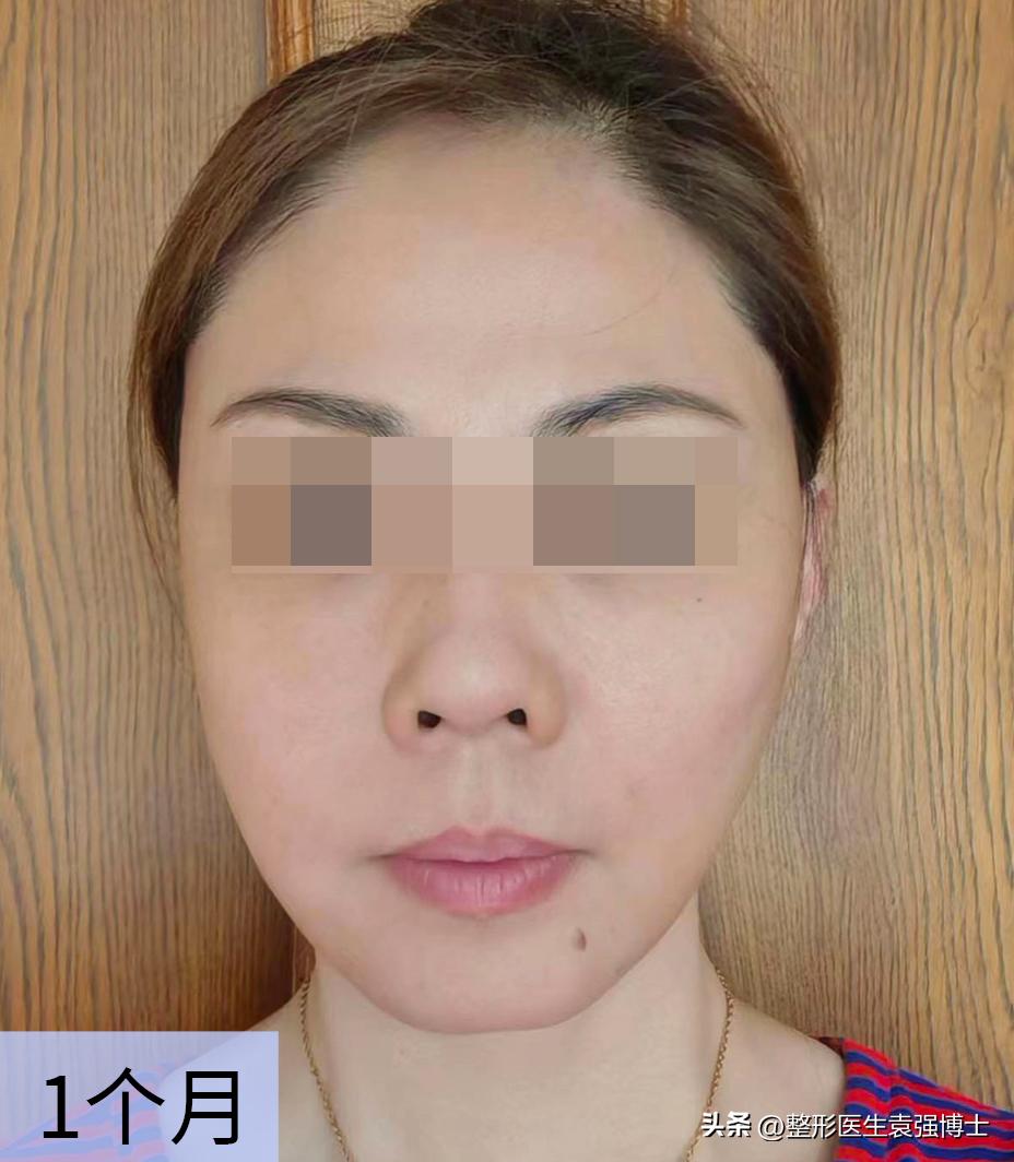 大拉皮多久可以修复大小脸,拉皮改善面部松弛