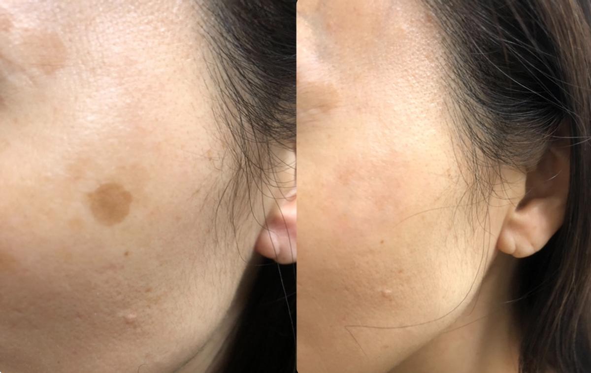 外泌体干细胞美容多长时间见效果,干细胞治疗老年斑多久能痊愈