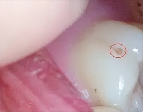 8岁孩子牙齿黑黑的怎么办,牙齿上有黑点儿怎么办