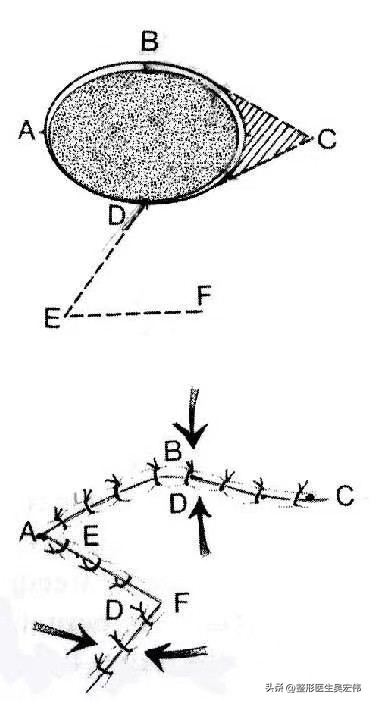 面部痣切除缝合不平整,面部痣可以去掉吗