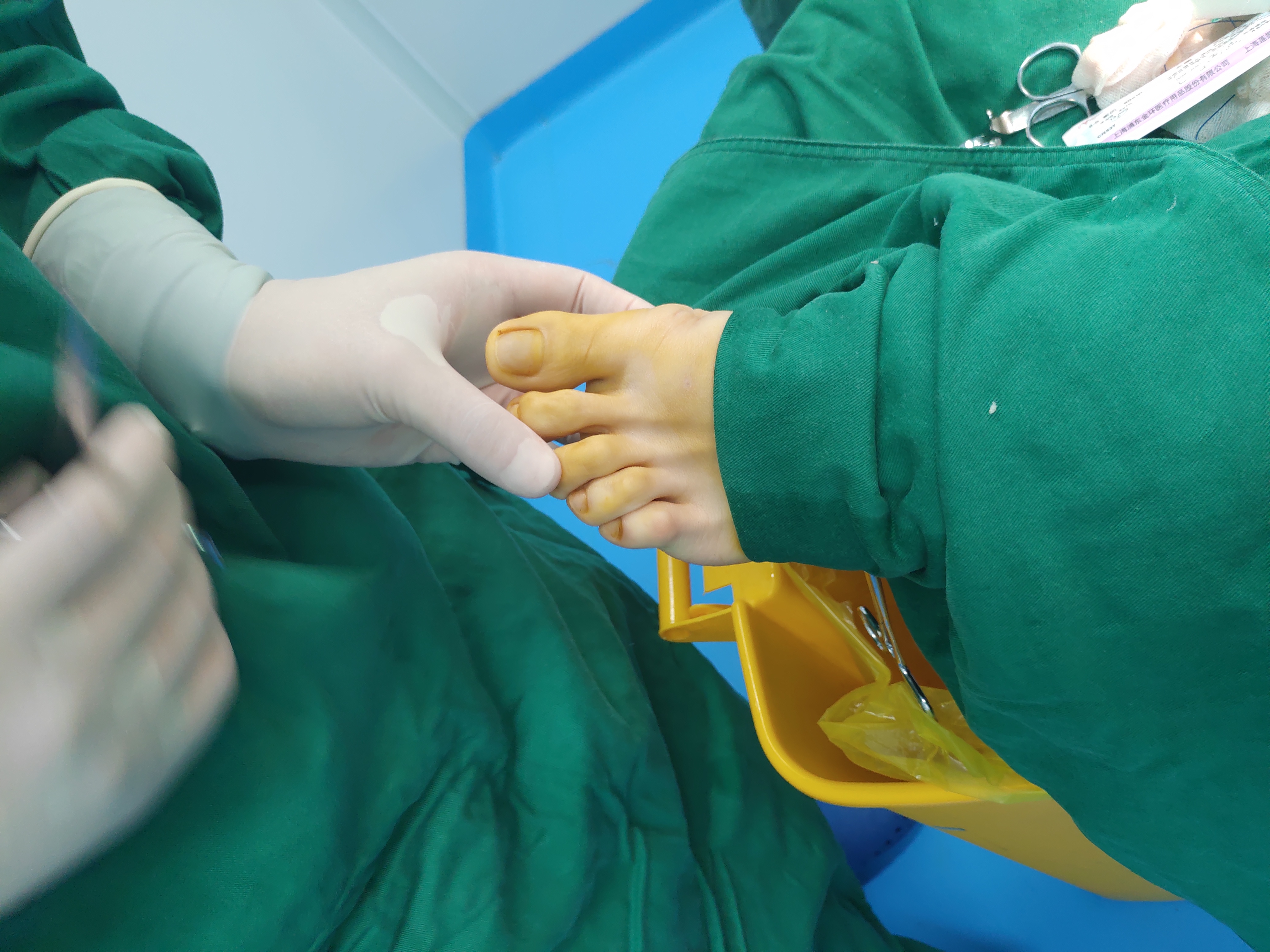 拇外翻是怎么形成的有什么危害,拇外翻的原因及处理方法