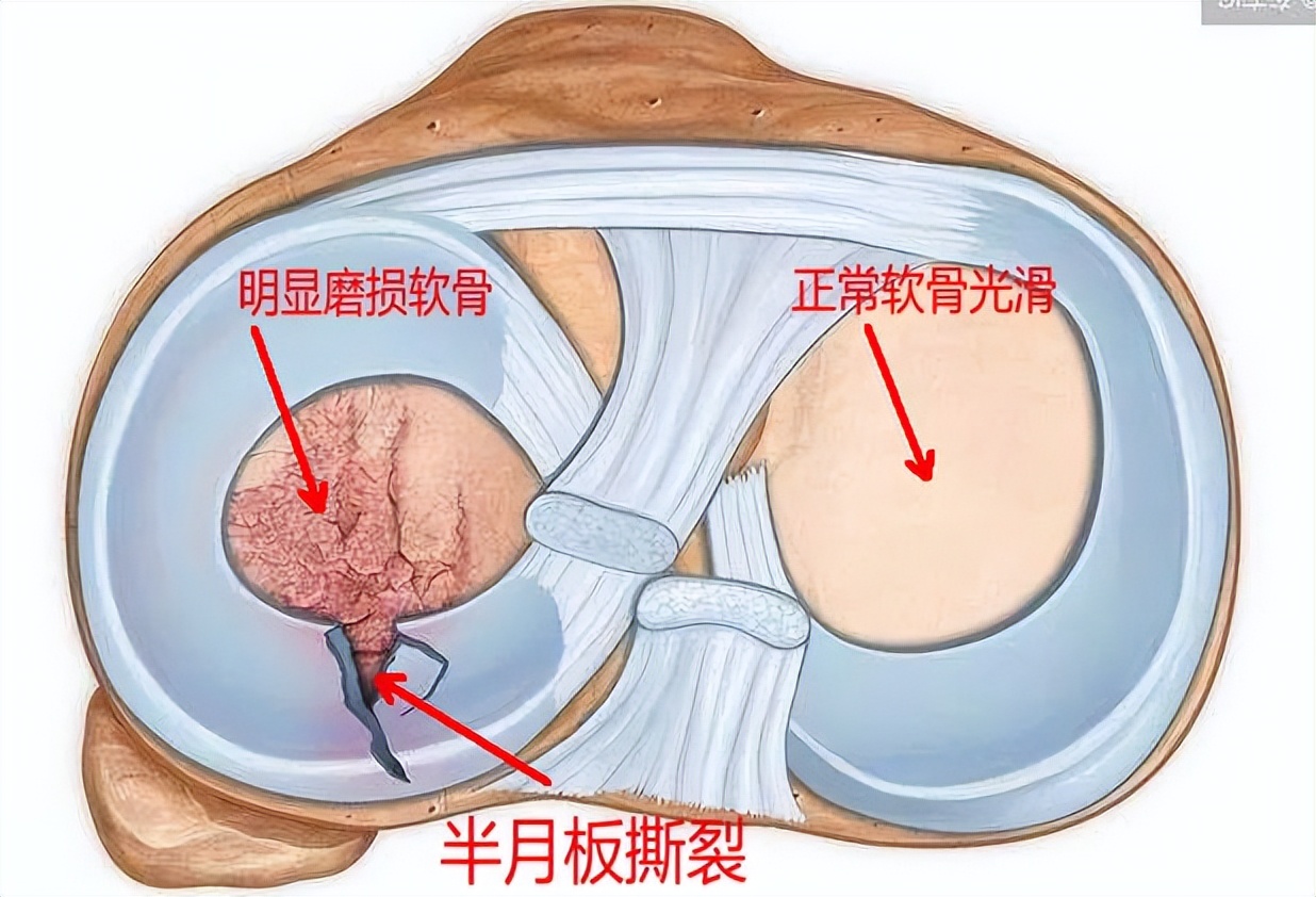 半月板损伤严重的状态是什么,半月板损伤应该注意什么问题