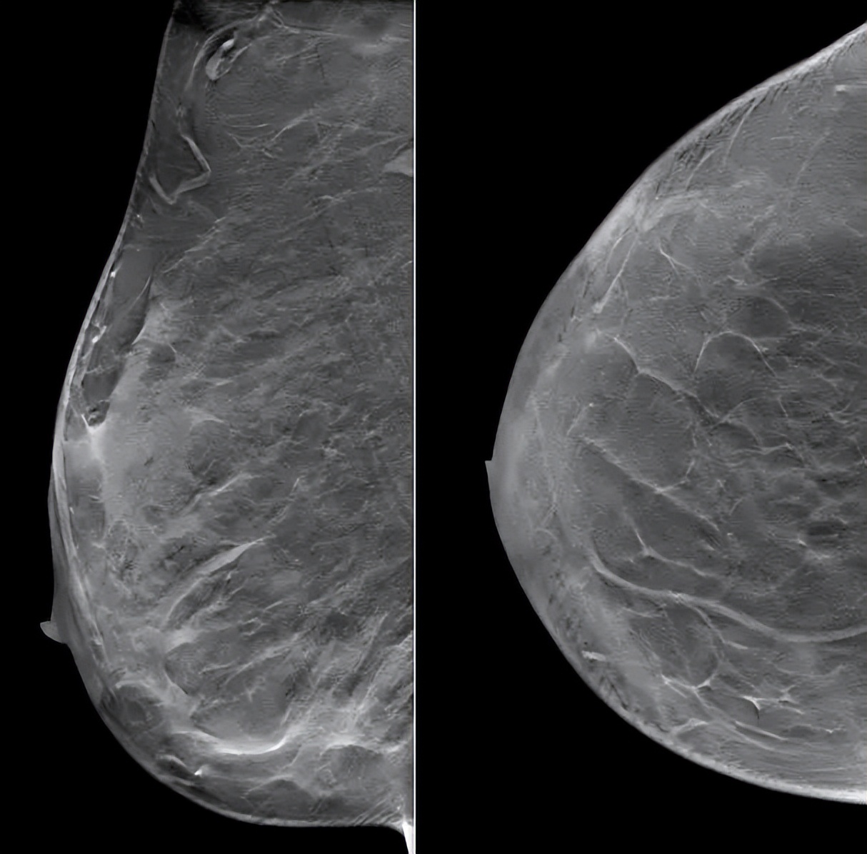 抗her2阳性治疗,双靶向治疗her2复发率