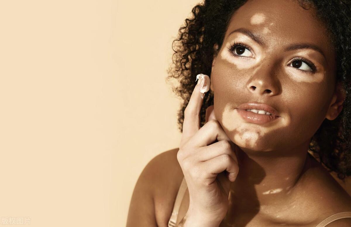 要想治好一定要选对方法,想要治好白癜风该注意什么呢