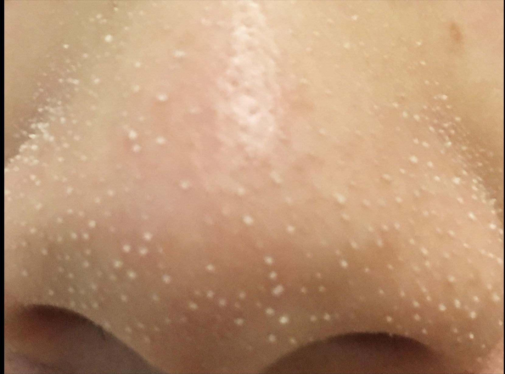 鼻子上好多黑头把毛孔堵住了,鼻子上的黑头怎么去除最有效方法