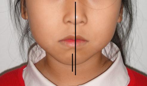 徐州儿童牙齿矫正牙齿不齐,大连口腔医院儿童牙齿矫正怎么样