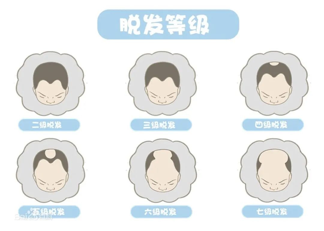 改善脱发秘方,改善脱发用什么