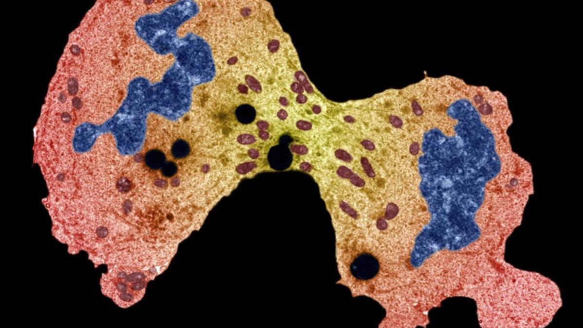 肉瘤容易误诊吗,肉瘤是不治之症吗