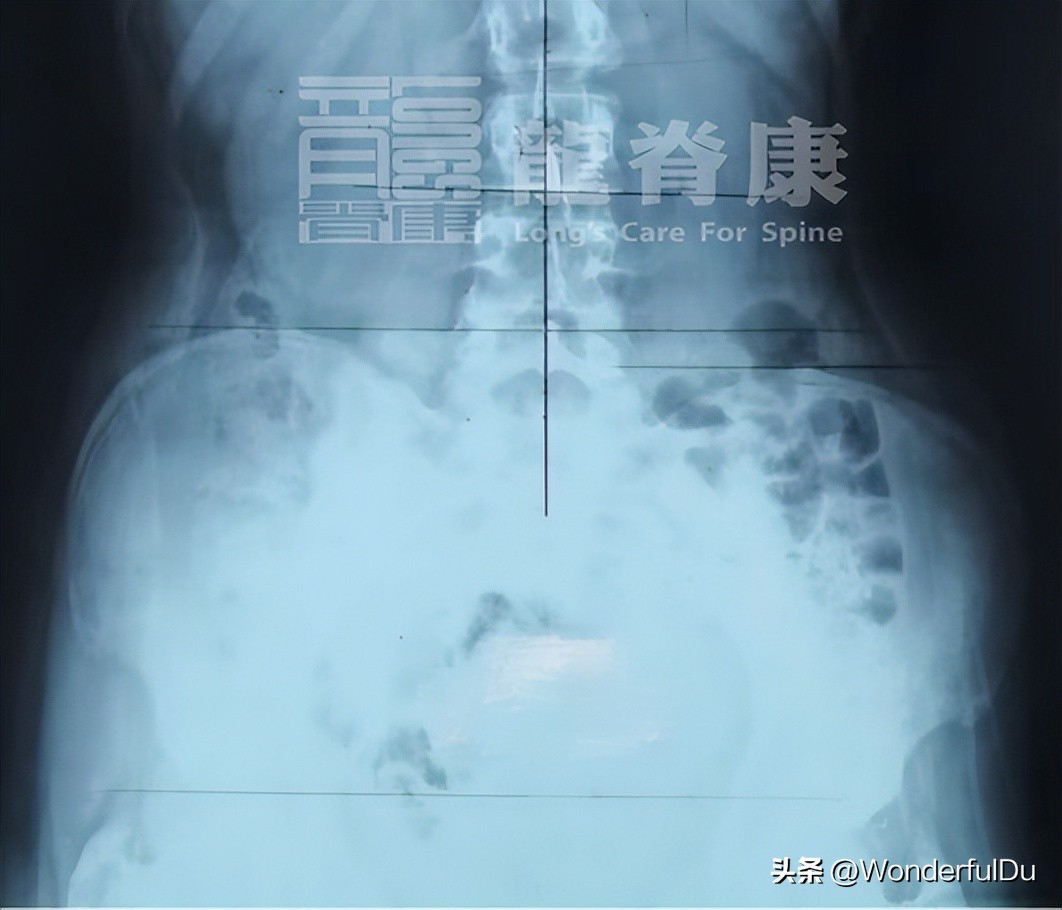 儿童脊柱侧弯导致长短脚怎样矫正,脊柱侧弯引起的长短脚能治愈吗