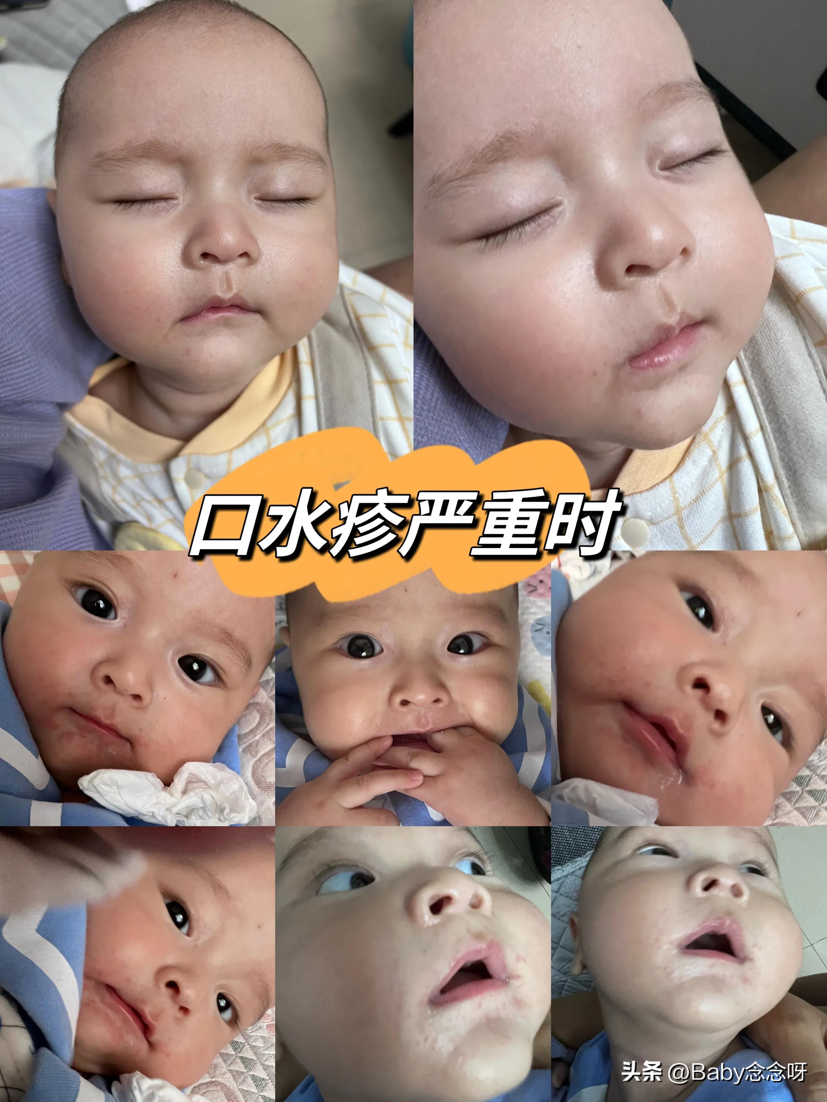 口水疹护理膏哪个好用,口水疹伤到真皮层怎么护理