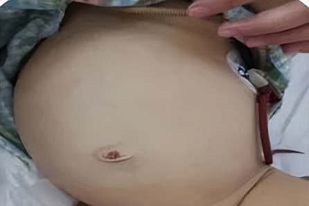 肝母细胞瘤有良恶之分吗,肝母细胞瘤罕见病