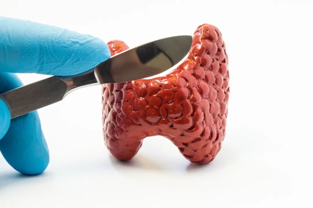 痰湿息肉,痰湿体质易患结节息肉