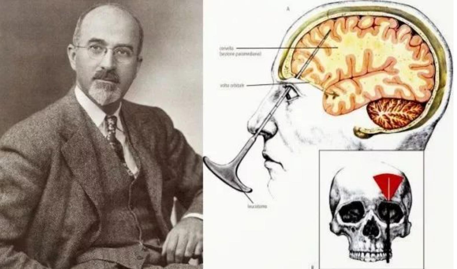 诺贝尔奖前额叶切除术,诺贝尔奖历史完整版