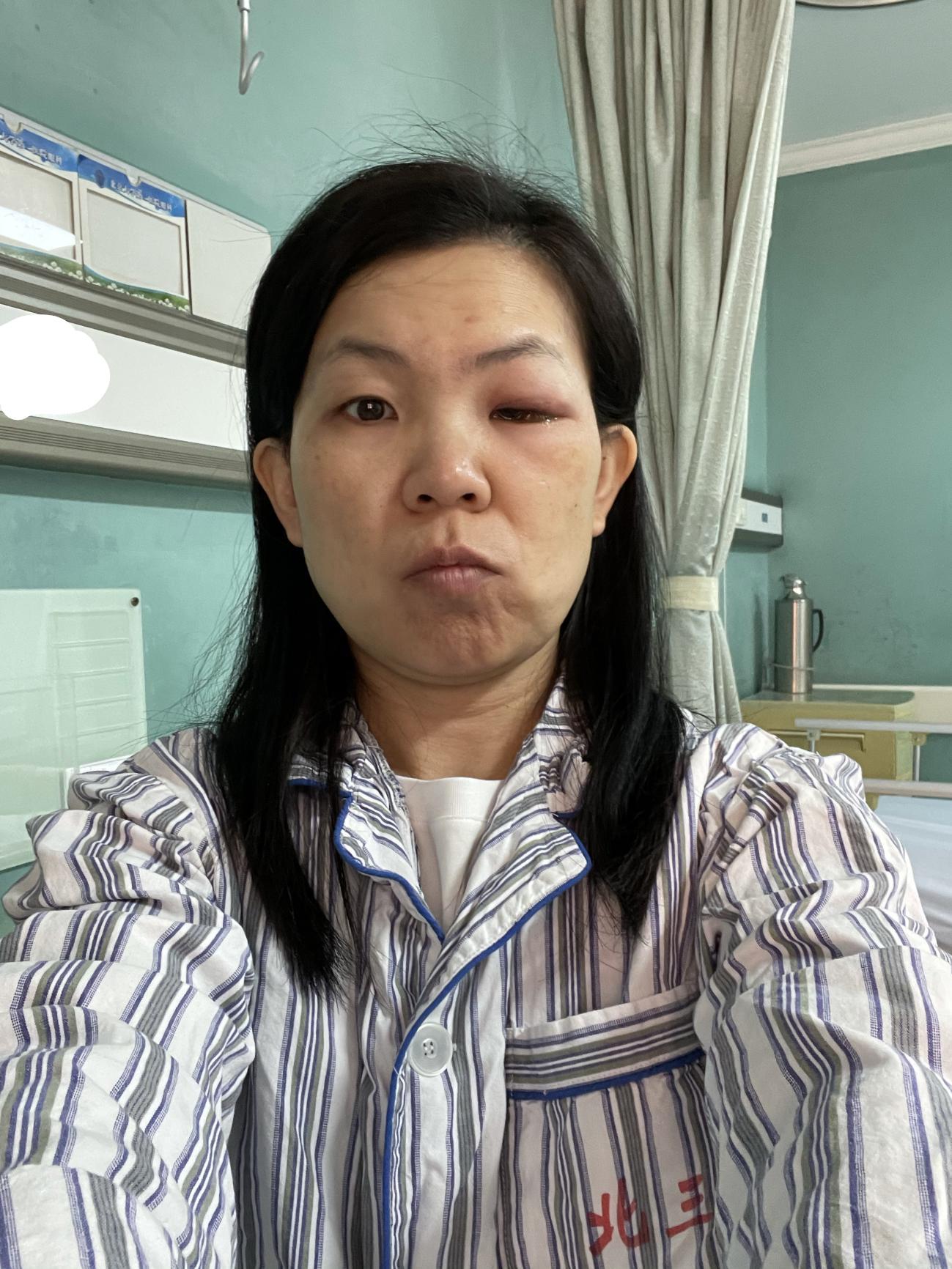 终于找到正确的医生治疗我的眼眶蜂窝织炎：详细记录住院康复经历