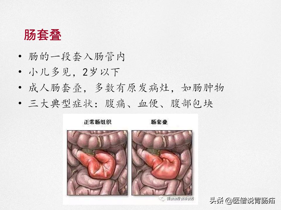 肠梗阻健康教育,肠梗阻患者的健康宣教