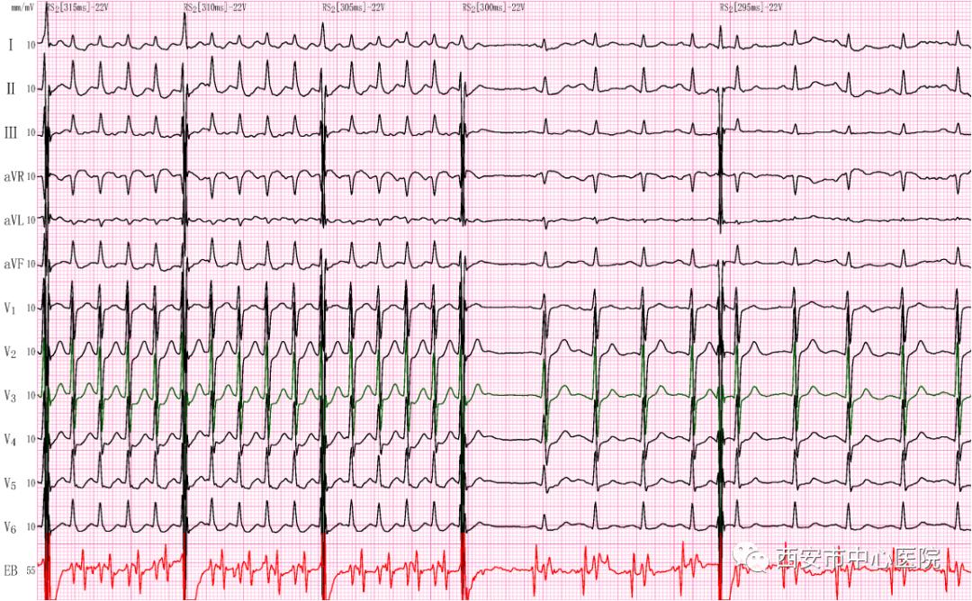 食道心电图正常可以排除什么疾病,食管内心电图和心脏调搏区别