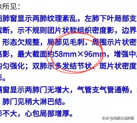 肺癌肝转移一个病灶,肺癌中药调理可以控制住吗