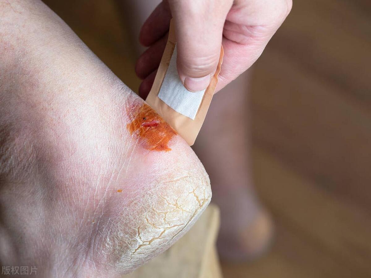 碘酒跟碘伏的区别在哪里,碘伏和碘酒是一个品种吗