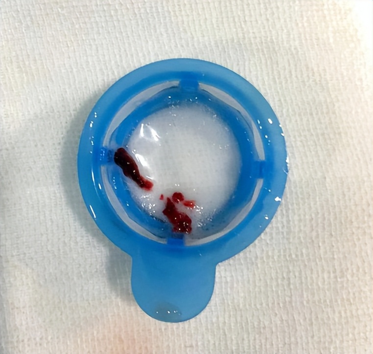 76岁老人心脏房颤是怎么引起的,80多岁老人持续房颤意味着啥