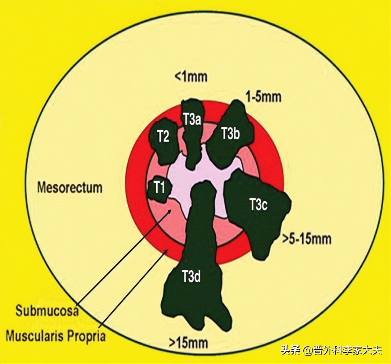直肠癌t3n1m0术前放化疗,肛管癌ct3n2m0治愈率