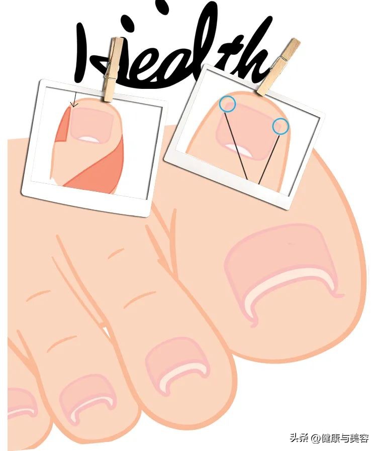 指甲卷曲内卷,指甲卷曲用什么药