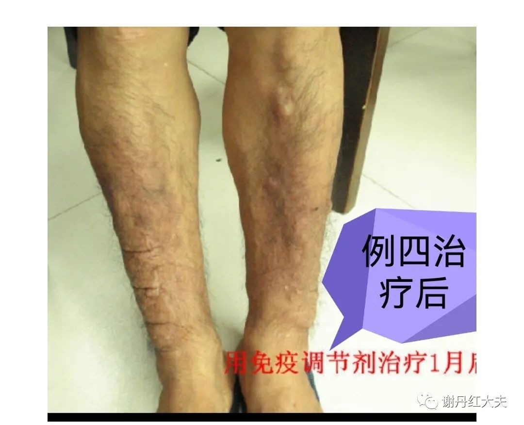 胫前黏液性水肿见于哪些病,胫前黏液性水肿为凹陷性水肿吗