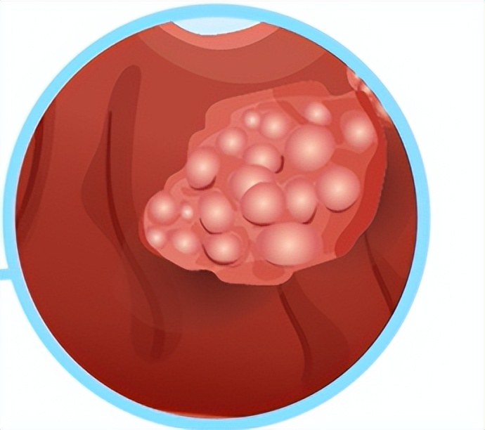 肠息肉癌变怎么提示,肠息肉出现征兆是不是已经癌变了