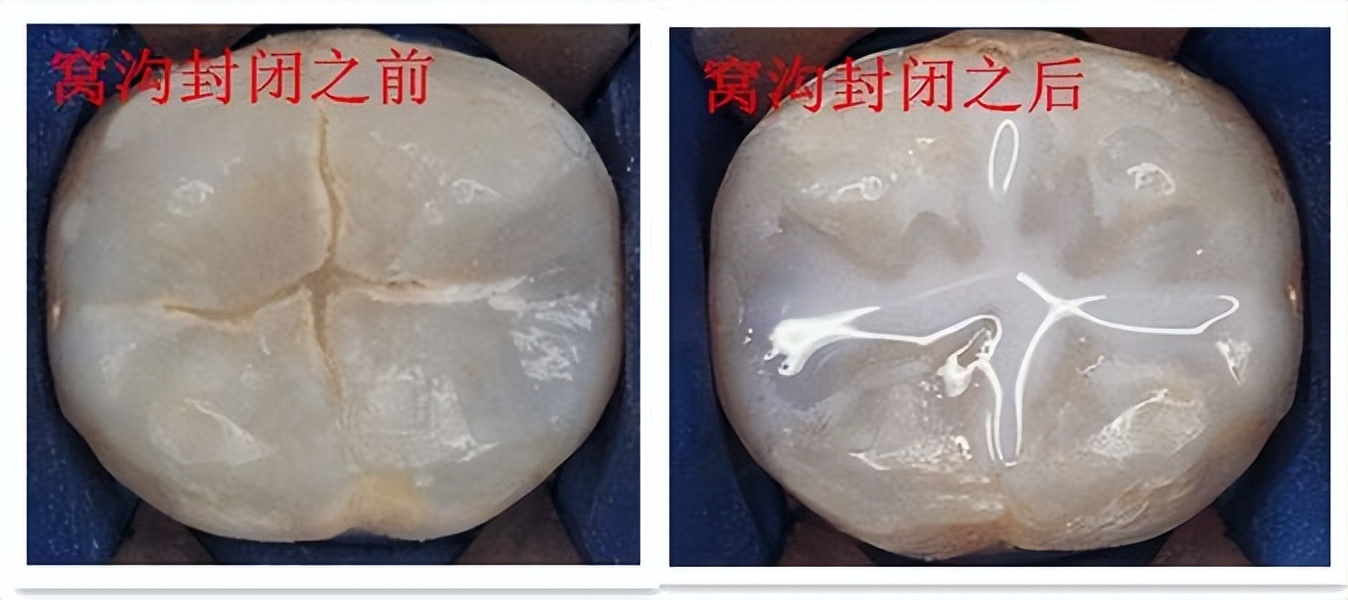 @所有家长:十个孩子九个蛀牙?只要做到这两点就可以避免