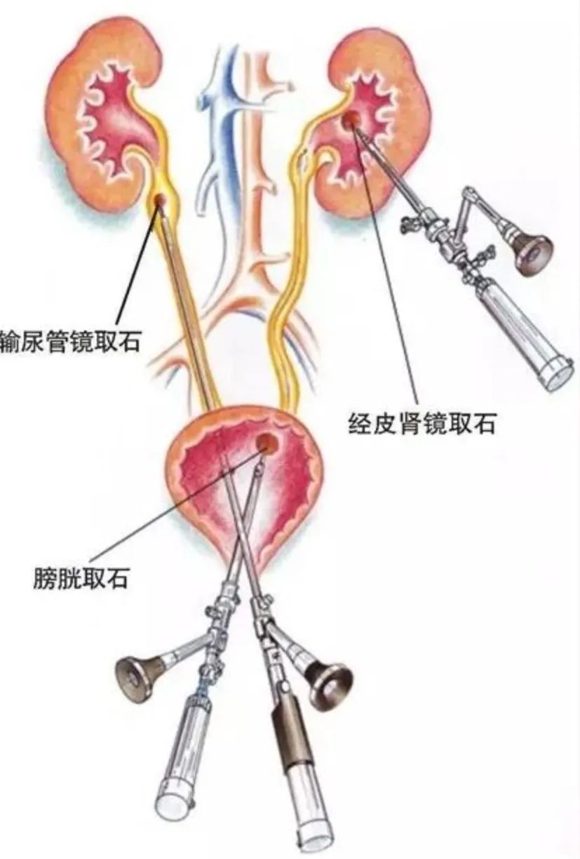 急性肾绞痛是几级,急性肾绞痛吃什么药止痛