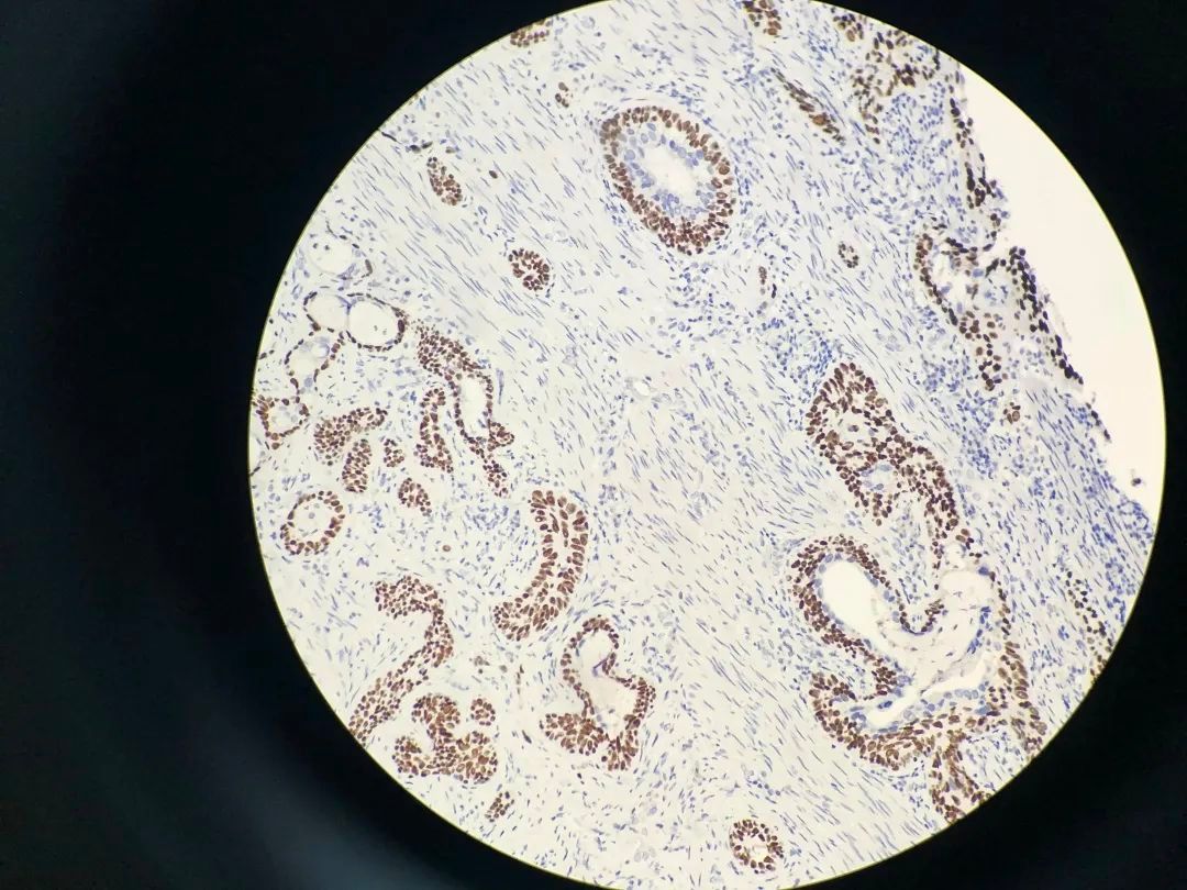 医生说病理报告有点小问题,病理报告没出来好害怕啊