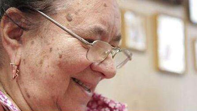 怎么用红霉素软膏祛除老年斑,快速消除老年斑的小妙招红霉素